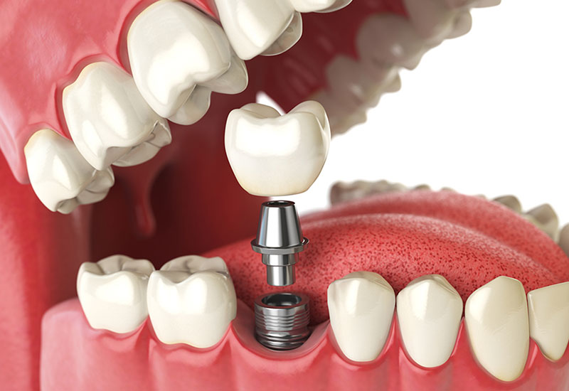 dental implants in se calgary