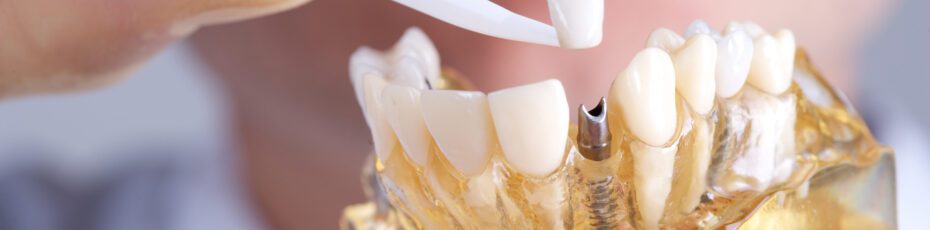 what are the benefits of dental implants